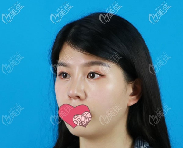 肋軟骨隆鼻一個月鼻小柱位置有點紅 肋軟骨隆鼻一個月鼻小柱位置有點紅