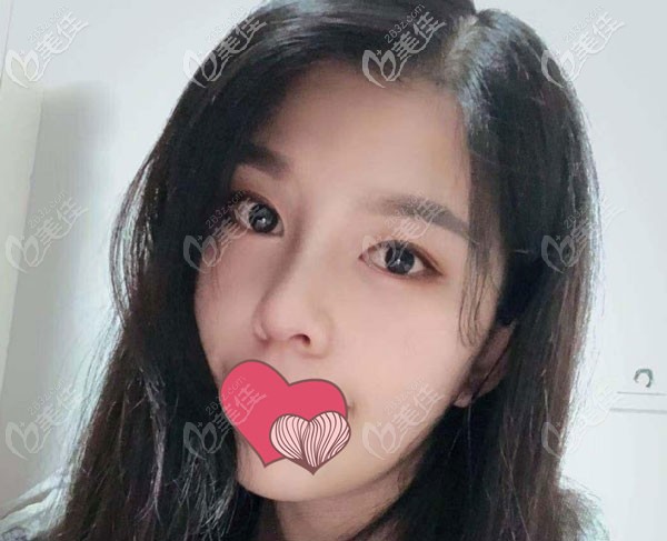 隆鼻術后40天鼻頭已經(jīng)有觸感 隆鼻術后40天鼻頭已經(jīng)有觸感