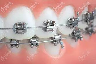 自鎖托槽 自鎖托槽