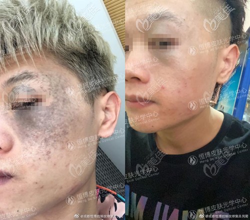 成都恒博去太田痣真人案例 成都恒博去太田痣真人案例