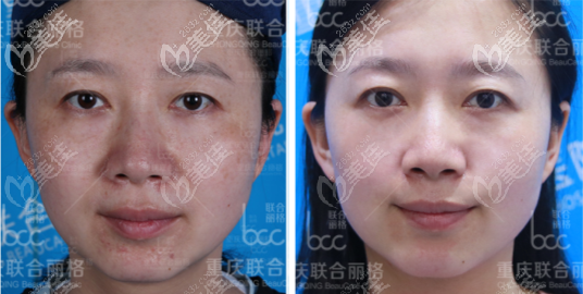 重慶聯(lián)合麗格祛黃褐斑案例 重慶聯(lián)合麗格祛黃褐斑案例