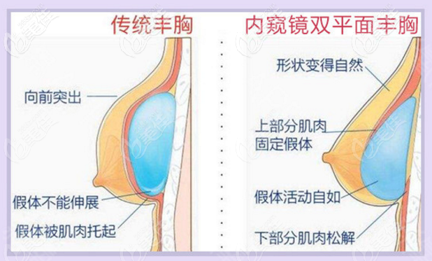 梅州曙光內(nèi)窺鏡雙平面隆胸技術(shù)優(yōu)勢