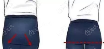 做提臀線術(shù)前術(shù)后對(duì)比照 做提臀線術(shù)前術(shù)后對(duì)比照