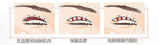 李耐國(guó)做雙眼皮手術(shù)的優(yōu)勢(shì)