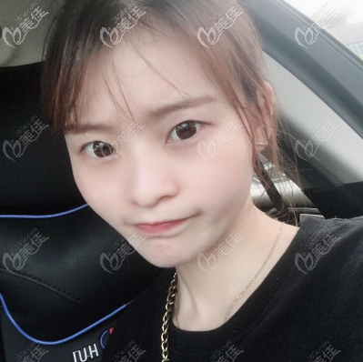 深圳博愛曙光雙眼皮術(shù)前照片 深圳博愛曙光雙眼皮術(shù)前照片