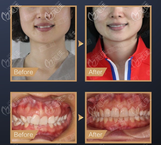 在成都新橋口腔戴隱形牙套矯正深覆頜的價(jià)格是多少?附效果圖