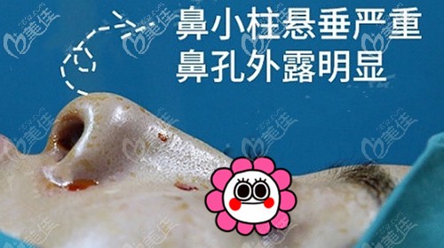 鼻翼緣退縮后出現(xiàn)的問題