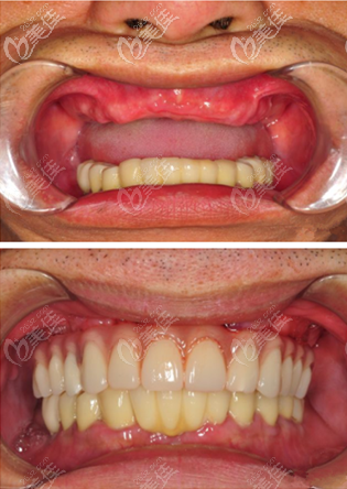 羅幼剛種植牙案例 羅幼剛種植牙案例