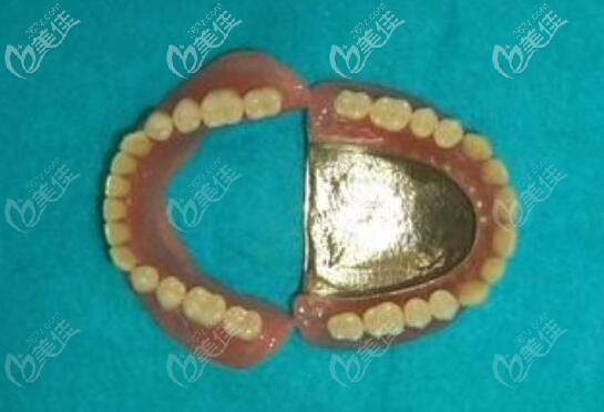 滿口種植牙真的不是要種28顆,我在廣州穗華口腔做的allon4全口種植牙就打了8個樁