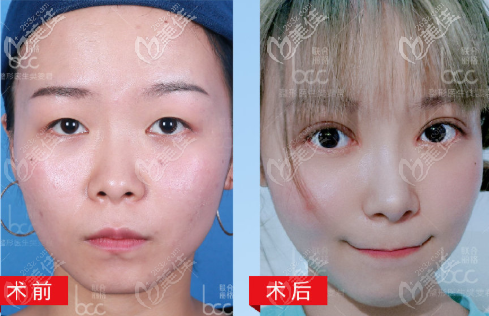 單眼皮變雙眼皮 單眼皮變雙眼皮