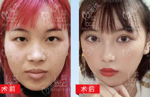 重慶聯(lián)合麗格內(nèi)眥贅皮矯正案例 重慶聯(lián)合麗格內(nèi)眥贅皮矯正案例