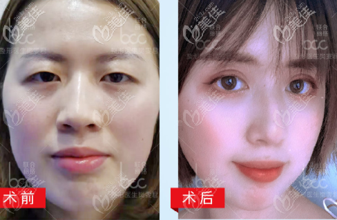 重慶黨寧醫(yī)生眼瞼提肌案例 重慶黨寧醫(yī)生眼瞼提肌案例