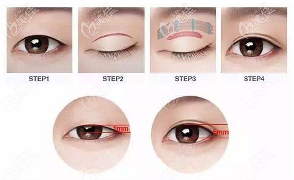 王潤先醫(yī)生做雙眼皮的技術(shù)優(yōu)勢 王潤先醫(yī)生做雙眼皮的技術(shù)優(yōu)勢