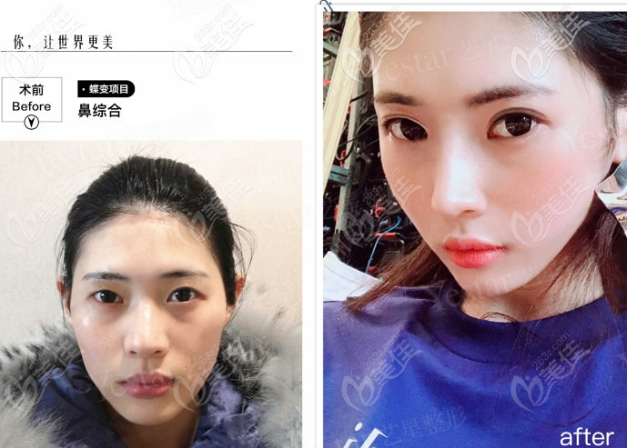 西安藝星做韓士生科一段假體隆鼻<span style=