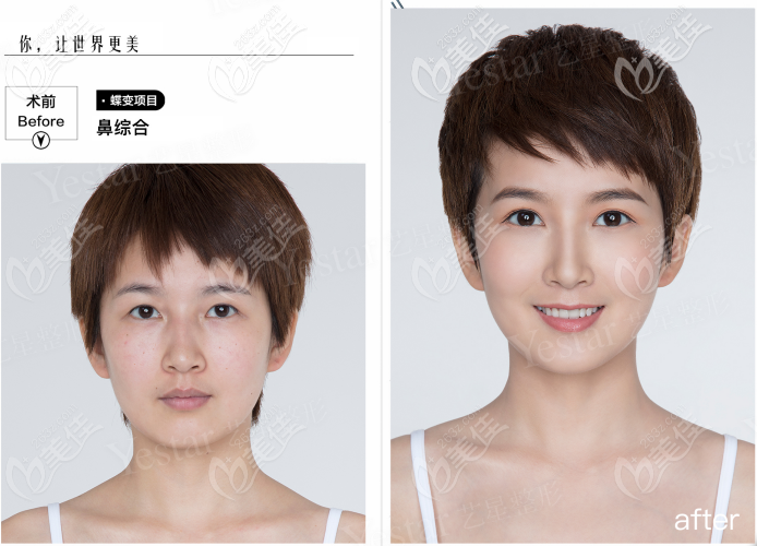 西安藝星做韓士生科一段假體隆鼻<span style=