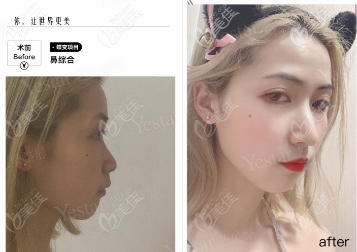 西安藝星做韓士生科一段假體隆鼻<span style=