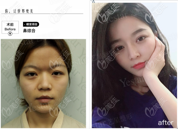 西安藝星做韓士生科一段假體隆鼻<span style=