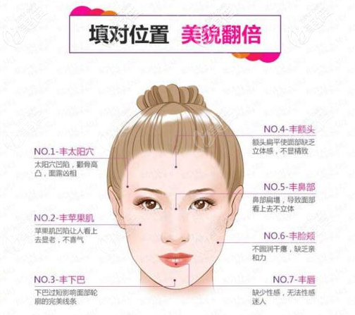  面部脂肪填充示意圖