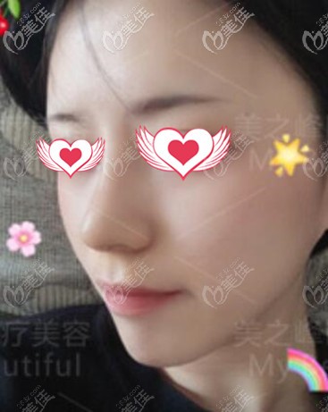 鼻綜合術(shù)后一周照