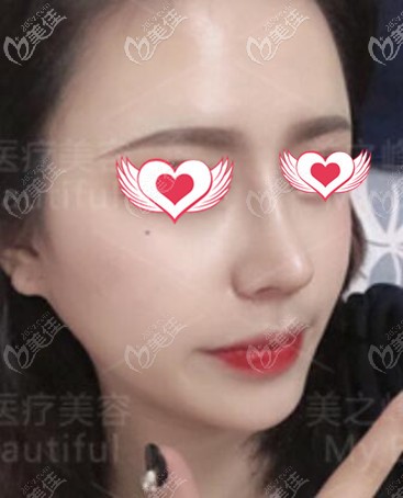 鼻綜合術(shù)后15天效果照