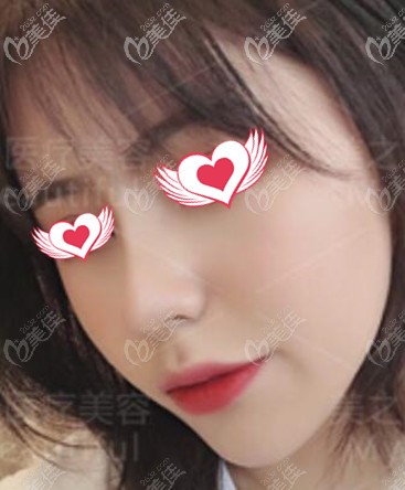 我在長沙美之峰做自體肋軟骨鼻綜合1個(gè)月了，效果還不錯(cuò)哦！