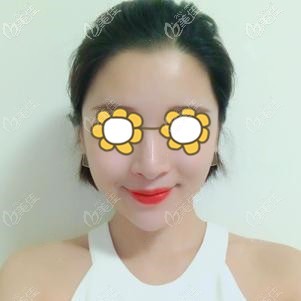 埋線提升適合脂肪多的肉肉臉嗎？去合肥安妮薇爾做了全臉埋線的我用實際案例告訴你們