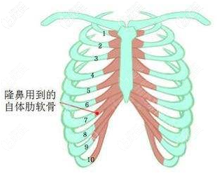 肋骨鼻取肋骨位置