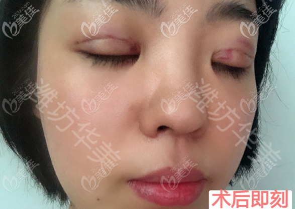 濰坊華美做埋線雙眼皮術(shù)后即刻照片