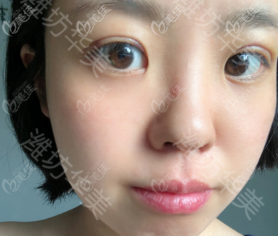 濰坊華美做埋線雙眼皮術(shù)后半個(gè)月的樣子