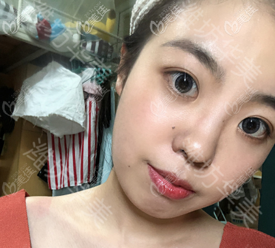 濰坊華美做埋線雙眼皮術(shù)后一個(gè)月的樣子
