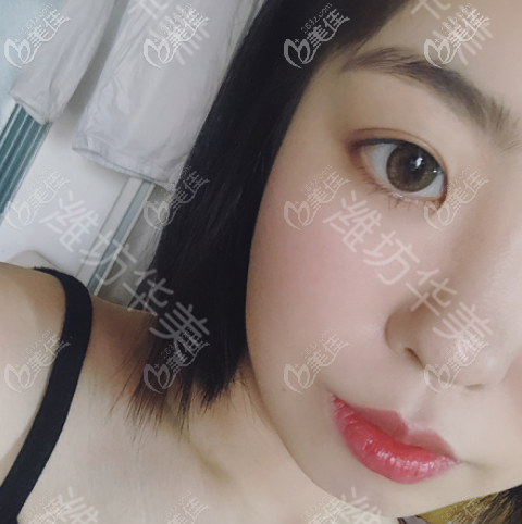 濰坊華美做埋線雙眼皮術(shù)后三個(gè)月的樣子