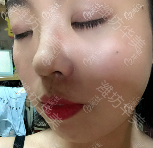 濰坊華美創(chuàng)和做埋線雙眼皮厲害，請參考真人日記