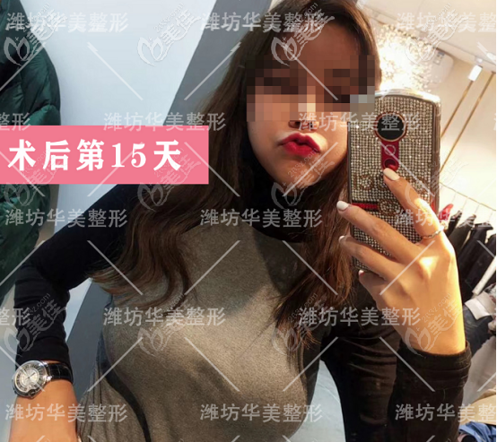 濰坊華美做隆胸的術后第15天狀態(tài)