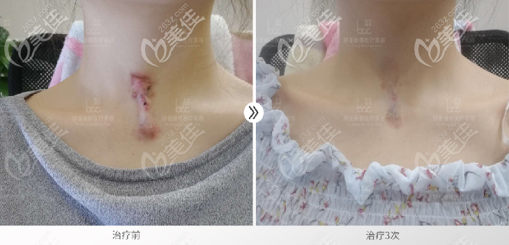 重慶鄭荃麗格祛疤案例 重慶鄭荃麗格祛疤案例