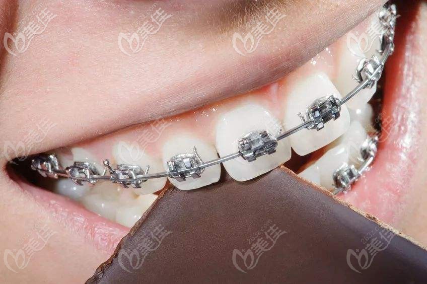 金屬托槽矯正 金屬托槽矯正