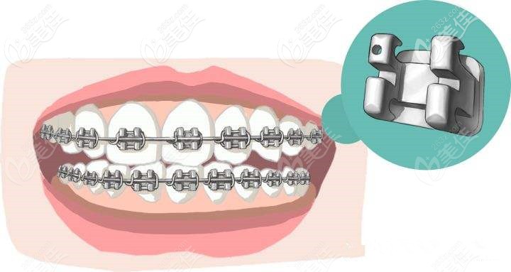 自鎖牙套的鎖扣 自鎖牙套的鎖扣