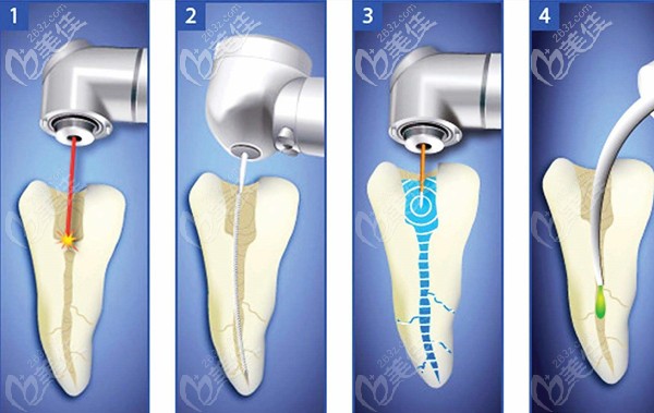 根管治療步驟及過程圖
