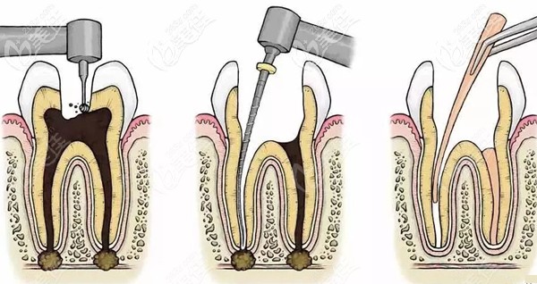 南京做一次性根管治療的費用