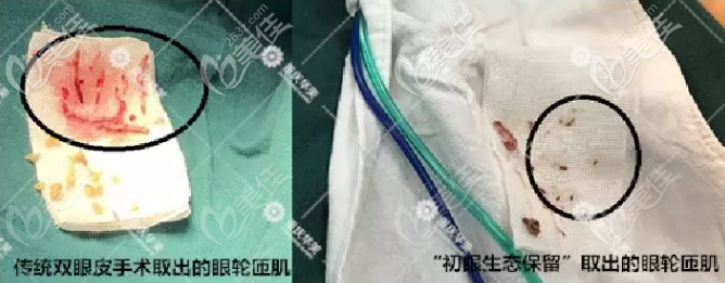 初眼生態(tài)保留術(shù)和傳統(tǒng)雙眼皮術(shù)的區(qū)別