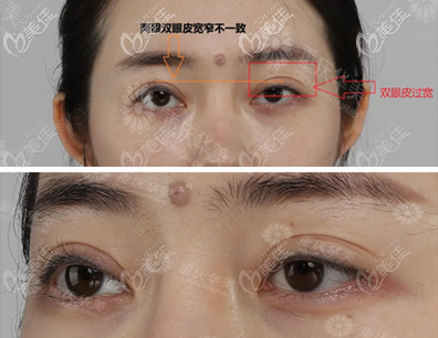 術(shù)前眼睛寬窄不一