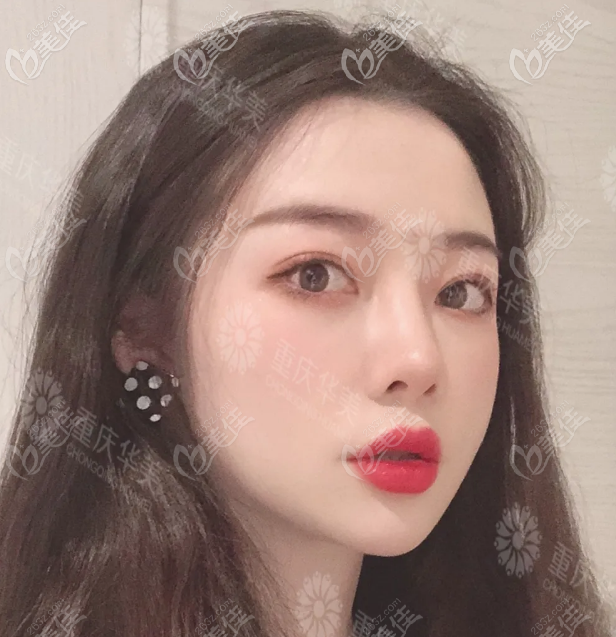 重慶華美雙眼皮寬改窄案例圖片