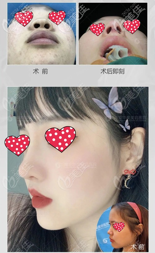 在南京華美做鼻修復前后對比案例