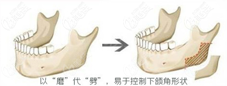 下頜角形狀更自然