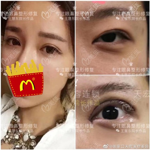 張家口天宏眼綜合對(duì)比案例