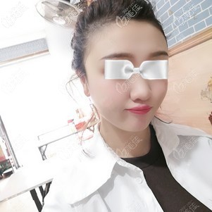 魏瑞鎖醫(yī)生為我做脂肪豐太陽(yáng)穴術(shù)后一周臉微腫 魏瑞鎖醫(yī)生為我做脂肪豐太陽(yáng)穴術(shù)后一周臉微腫