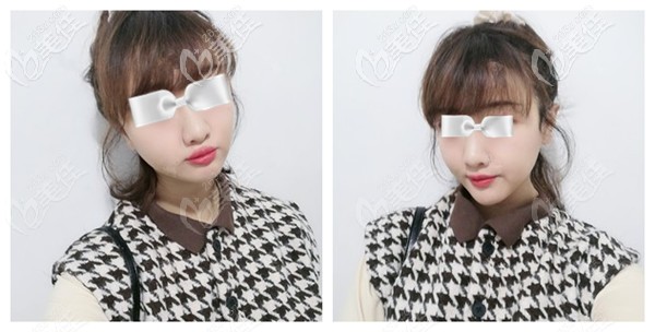 魏瑞鎖醫(yī)生為我注射脂肪豐太陽(yáng)穴術(shù)后完全消腫 魏瑞鎖醫(yī)生為我注射脂肪豐太陽(yáng)穴術(shù)后完全消腫