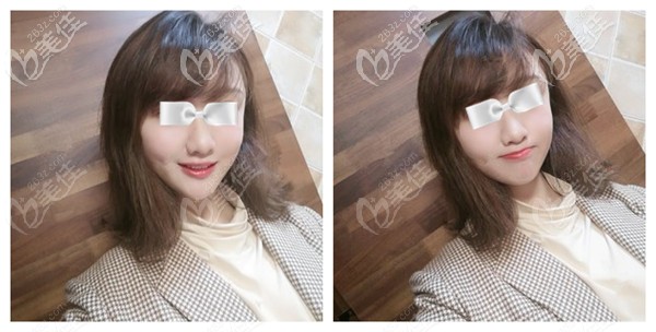 在石家莊創(chuàng)美做脂肪填充太陽(yáng)穴術(shù)后恢復(fù)自然 在石家莊創(chuàng)美做脂肪填充太陽(yáng)穴術(shù)后恢復(fù)自然