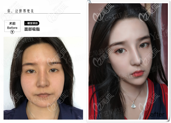 水動(dòng)力3.0面部吸脂<span style=