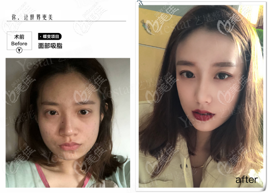 西安哪里做水動(dòng)力面部吸脂好？原來(lái)西安藝星做水動(dòng)力吸脂挺自然的