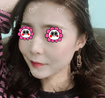 北京加減美V美減齡V3定格青春術(shù)案例 北京加減美V美減齡V3定格青春術(shù)案例